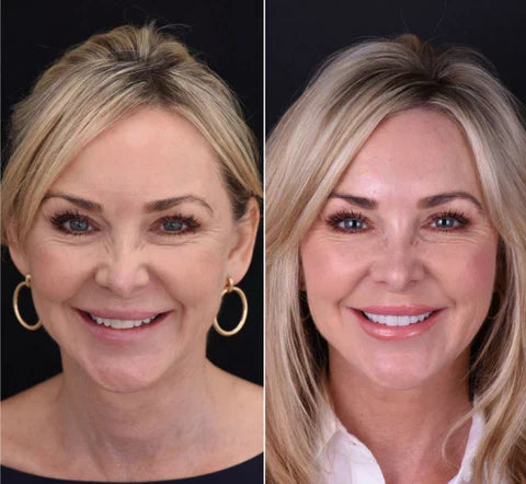 Cosmetische Tandfacet Set Boven & Onder Verstelbaar Vormbaar Herbruikbaar Natuurlijk Wit Instant Smile