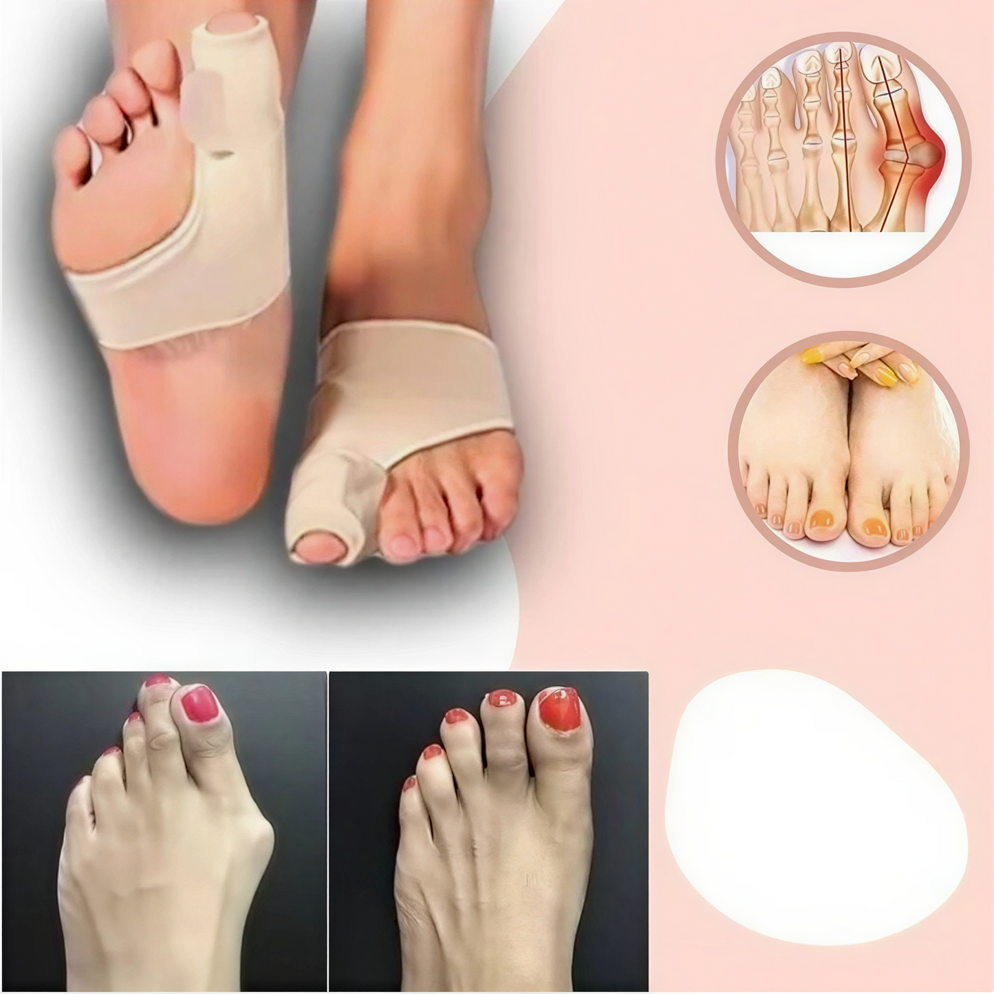 Teencorrector Hallux Valgus Gel Siliconen Voetorthese Teenstandverbetering Comfortabel Draagbaar Pijnverlichting