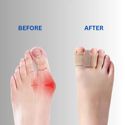 Teenspreiderset Siliconen voor Hallux Valgus en Overlappende Tenen – Zachte Correctie & Pijnverlichting
