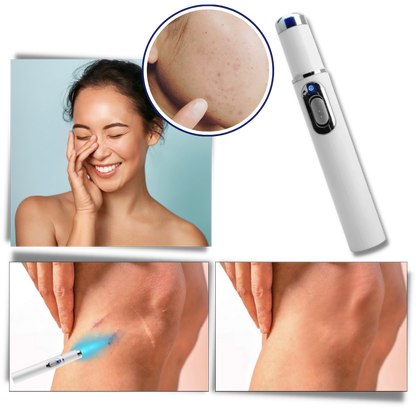 Huidverzorgingspen met Blauwe Lichttherapie tegen Pigmentvlekken en Littekens | Draagbaar Huidverjonging Apparaat voor Thuisgebruik | Precisie Laserbehandeling Hyperpigmentatie Vermindering Anti-Aging