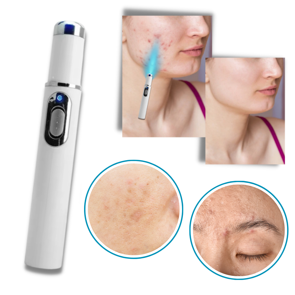 Huidverzorgingspen met Blauwe Lichttherapie tegen Pigmentvlekken en Littekens | Draagbaar Huidverjonging Apparaat voor Thuisgebruik | Precisie Laserbehandeling Hyperpigmentatie Vermindering Anti-Aging