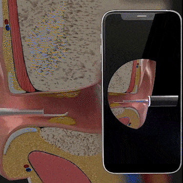 Oorexamen Camera met Siliconen Reinigingsopzetstuk en LED-Verlichting